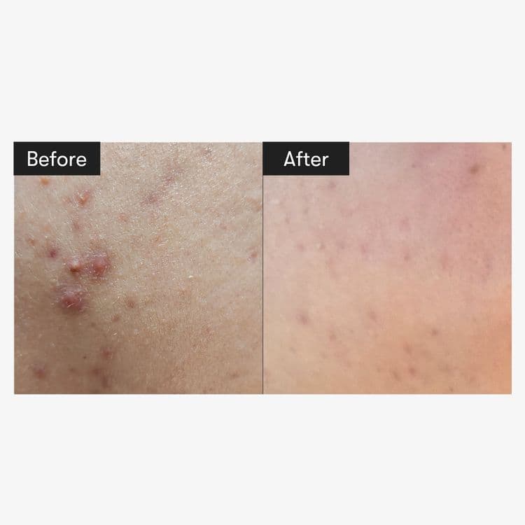 Vt Cosmetics Reedle Shot 100 Stick 2ml (10ea)